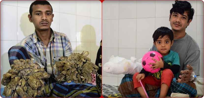 الشاب البنغالي عبد الباجندار، الذي عرف في وسائل الإعلام بـ "الرجل الشجرة"